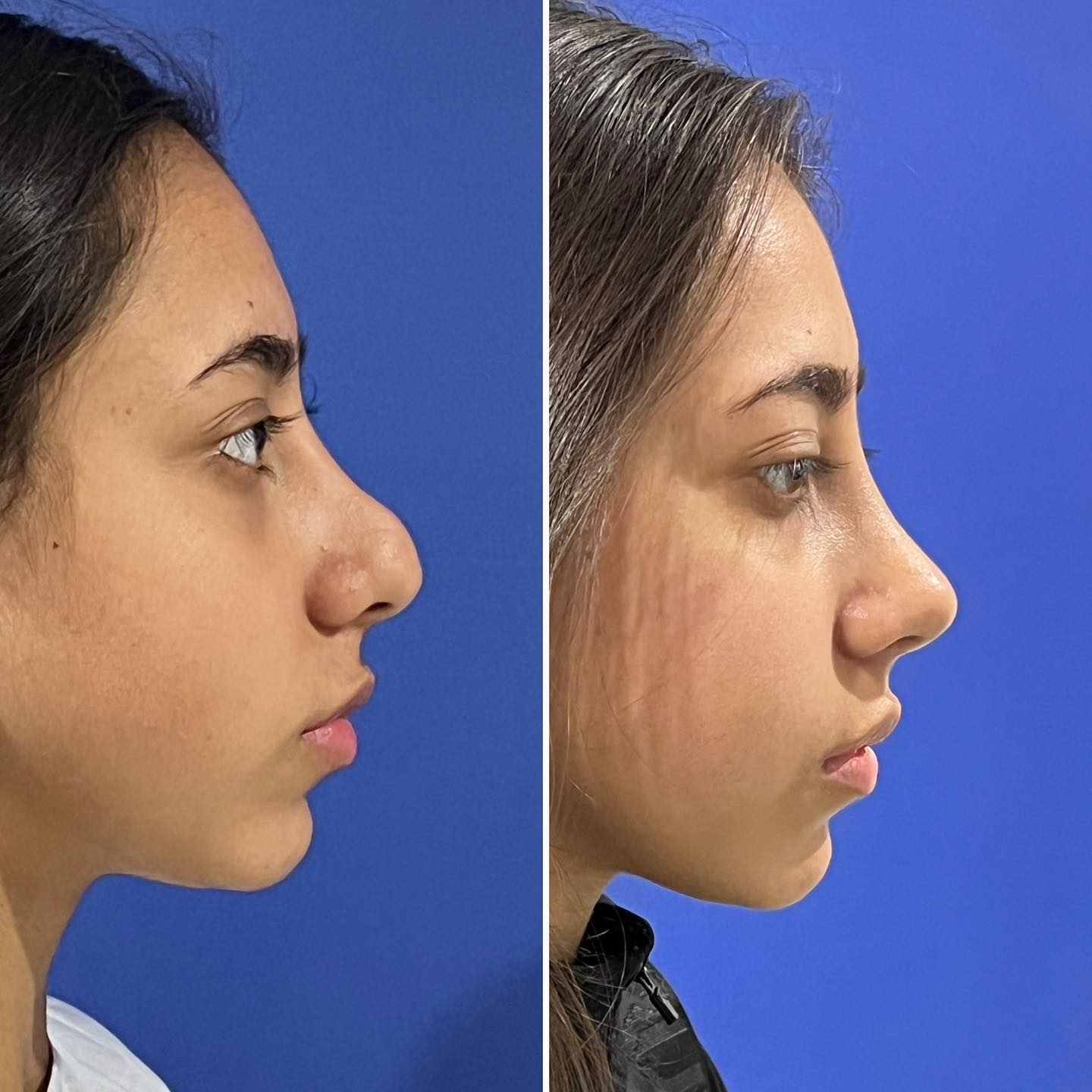 Rinoplastia ultrasónica Reconstructiva