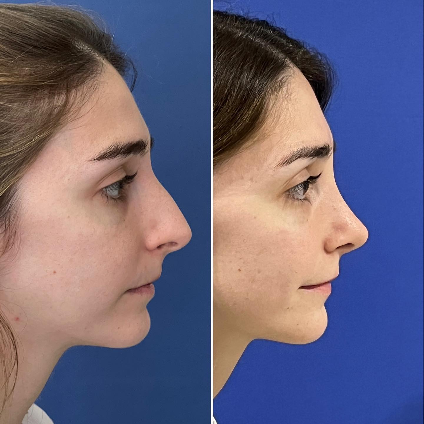 Rinoplastia estructural ultrasónica con preservación de dorso