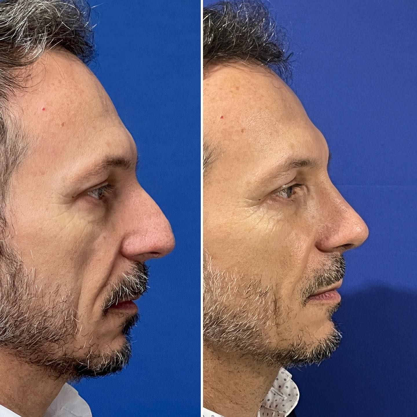 Rinoplastia ultrasónica masculina