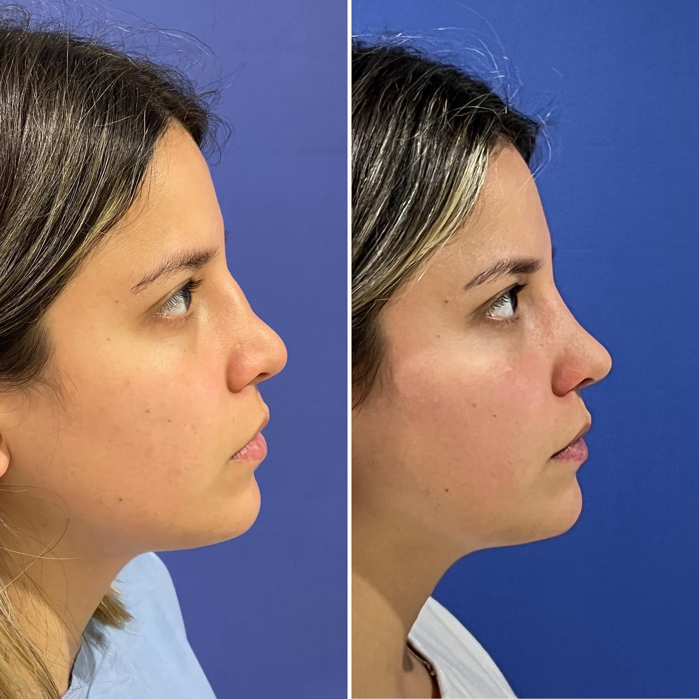 Rinoplastia Reconstructiva